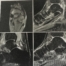 MRI showing navicular and talar head fracture